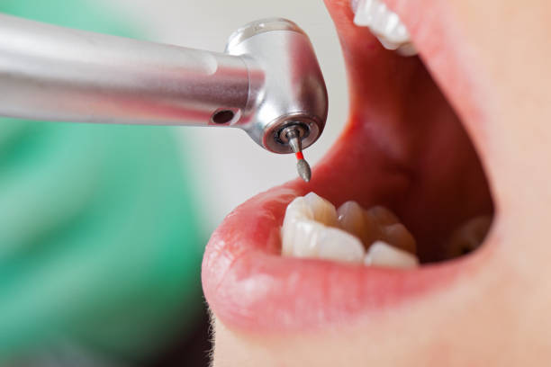 Best Emergency Treatment for Toothache in Salinas, CA